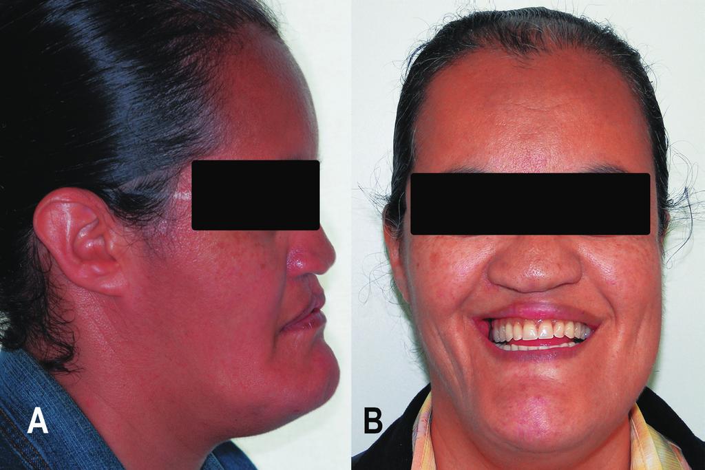 The case was concluded after orthognathic surgery and the patient was satisfied with the cosmetic and functional outcome and was reintegrated into