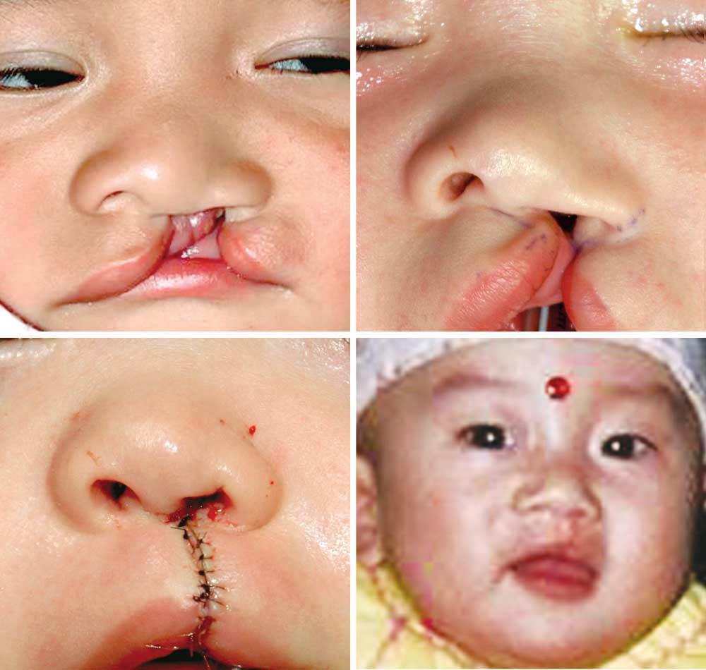 A C D Figure 3. A, Preoperative photograph of an 11-month-old child with a left cleft lip-palate that includes the alveolus.