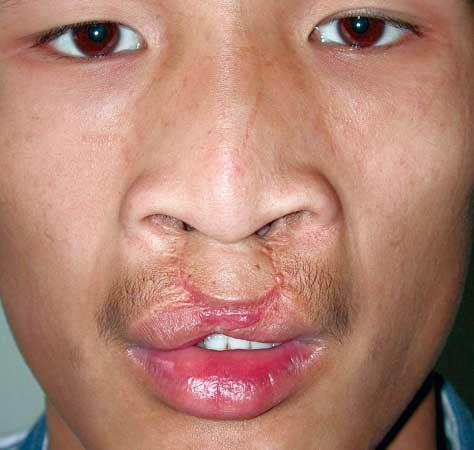 in asymmetry of the alar margin and the nostril size and shape., Close-up photograph demonstrating the lackof white roll continuity and deficiency at the lip closure site.