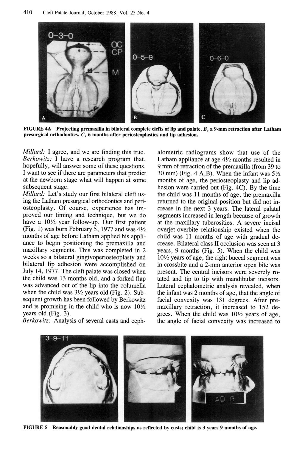 410 Cleft Palate Journal, October 1988, Vol. 25 No. 4 FIGURE 4A Projecting premaxilla in bilateral complete clefts of lip and palate. B, a 9-mm retraction after Latham presurgical orthodontics.