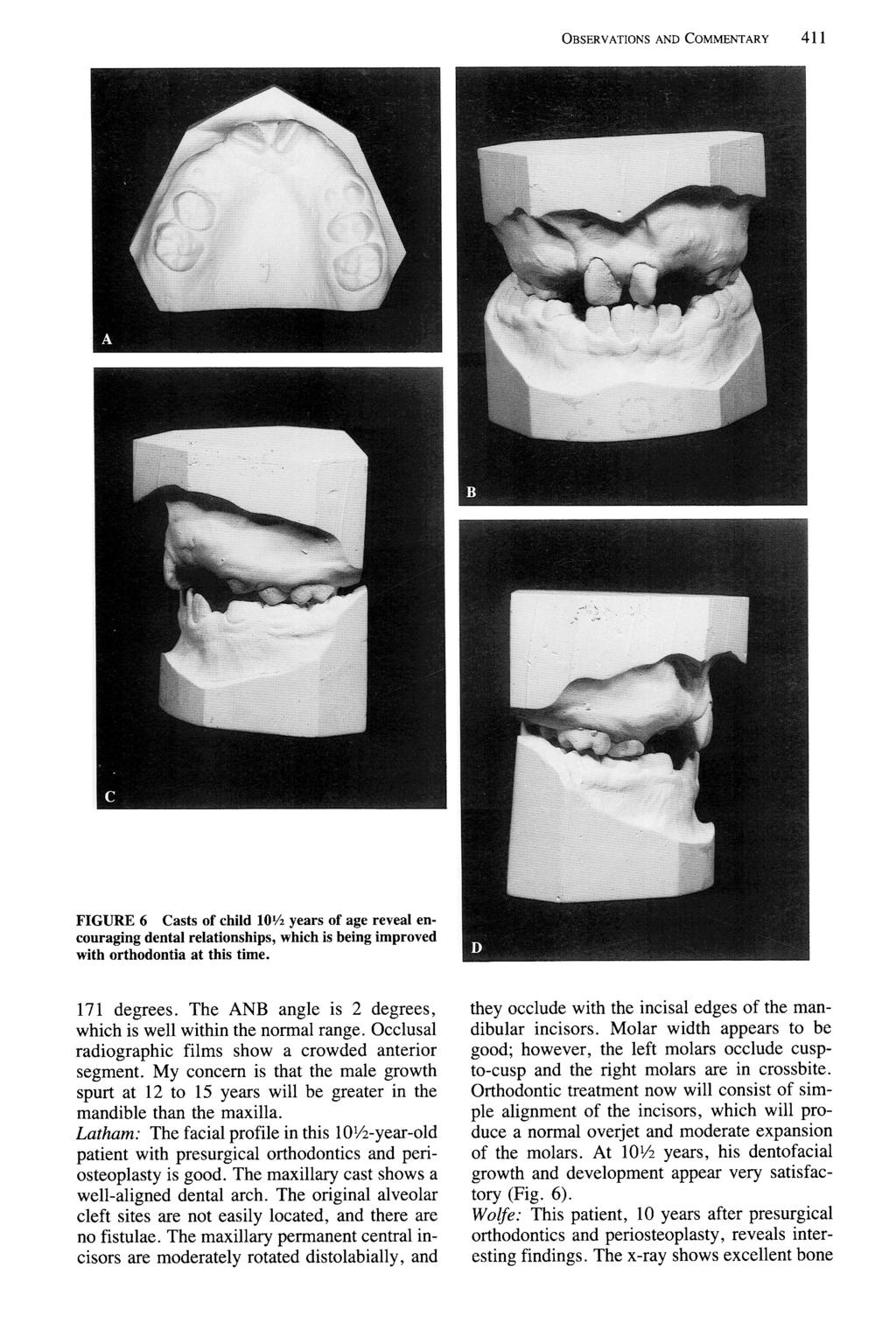 OBSERVATIONS AND COMMENTARY 411 FIGURE 6 Casts of child 10% years of age reveal encouraging dental relationships, which is being improved with orthodontia at this time. 171 degrees.