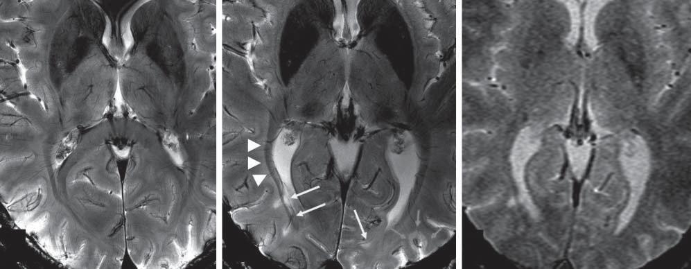 A B C Figure 2. Seven-tesla, T2*-weighted magnetic resonance images at the level of the basal ganglia in a healthy control (A) and a 54-year-old woman with multiple sclerosis (patient 1) (B).