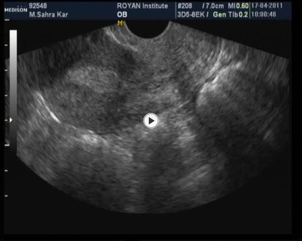 Fig. 8: In conventional TVS a thickened endometrial line is evident.
