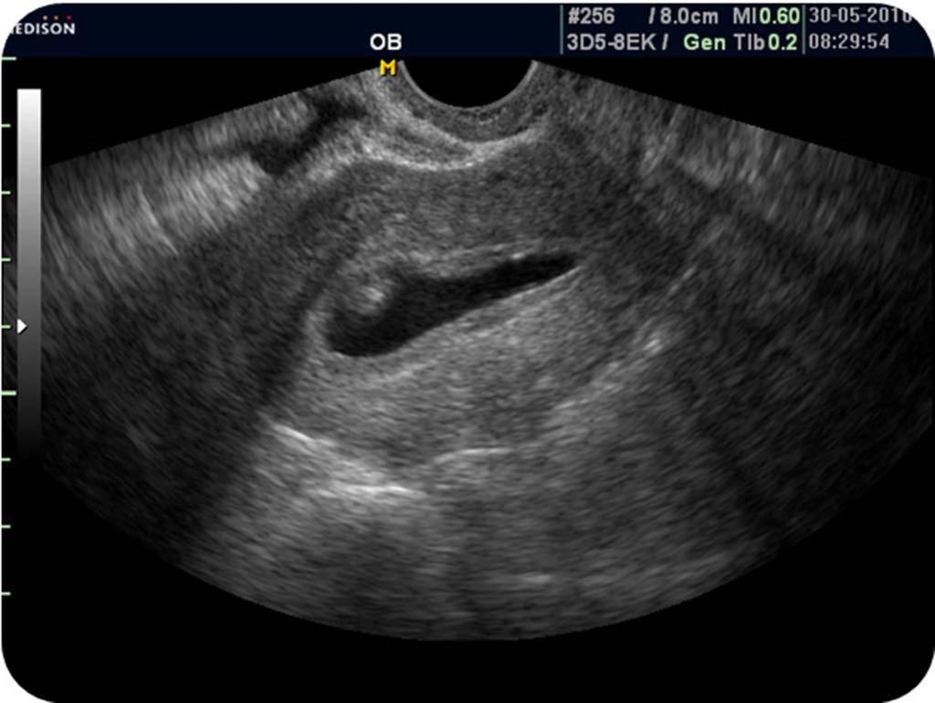 Fig. 4: Focal thickening of endometrium due to endometrial polyp and diffuse thickening of endometrium