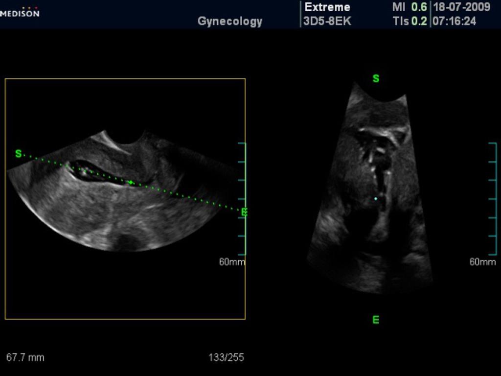 Fig. 5: Coronal reconstructed image shows thick echogenic bands due to uterine