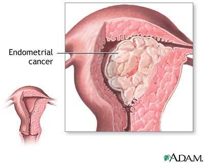 Post menopausal bleeding and endometrial cancer Most common gyn cancer (>40,000 cases annually) Postmenopausal vaginal