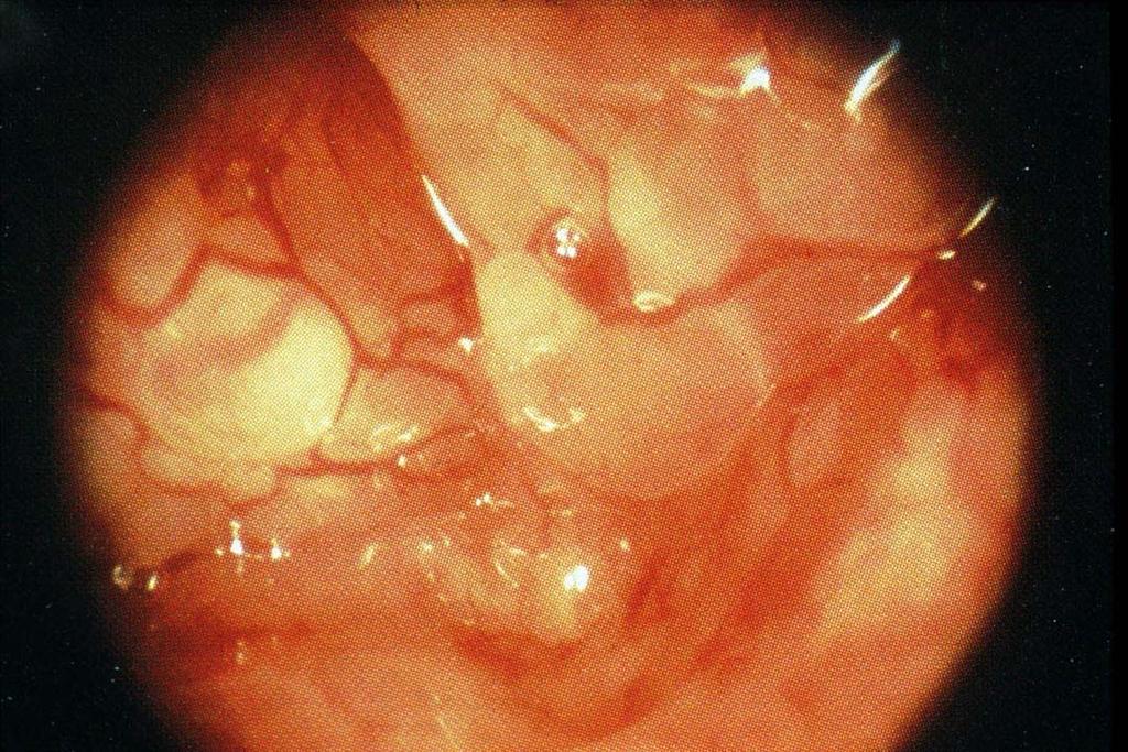 Endometrial Hyperplasia Slide