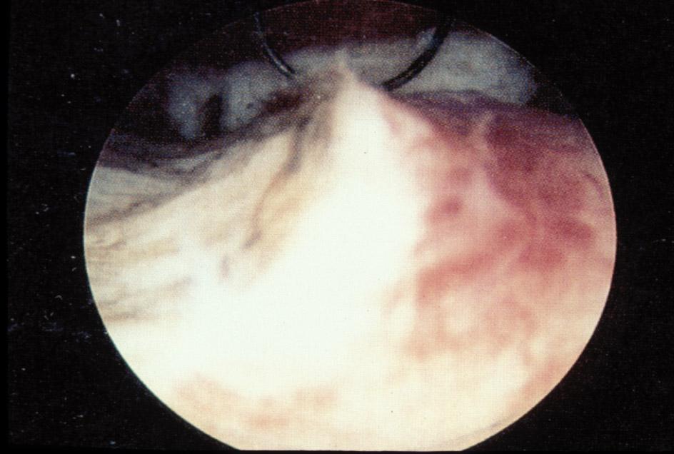 Electrosurgical Endometrial