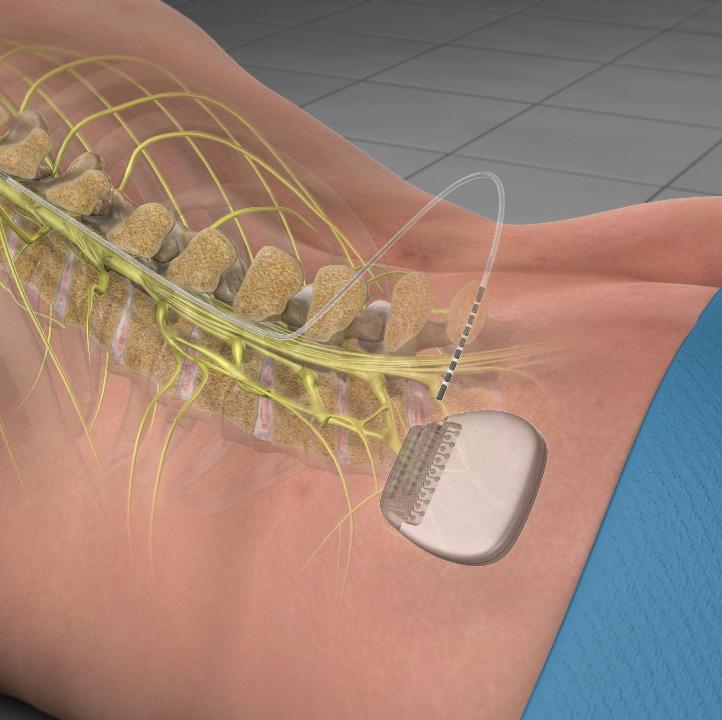 Spinal Cord Stimulator (SCS) To treat patients with Failed Back Surgery Syndrome (FBSS), complex regional pain syndrome, or for patients whose pain cannot be managed or resolved with decompression or