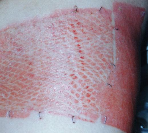 Disadvantages of Auto-Skin Graft Painful ~ creates new wound Donor site scaring ~ pigment changes Delay in wound closure ~ waiting for donor sight to heal