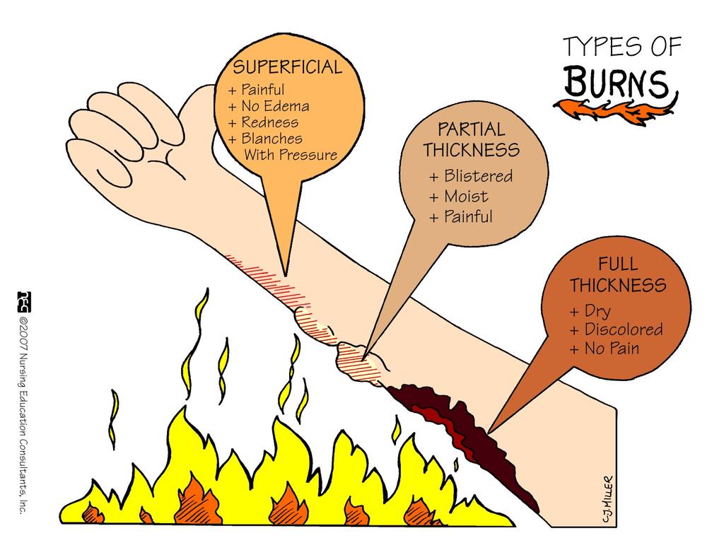 Depth of Burn Injury Burn depth is determine by assessing: Color
