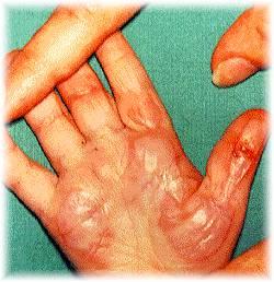 Depth of Burn Injury Superficial ~ 1 st degree Similar to a sunburn Epidermis is injured, dermis unaffected Red,