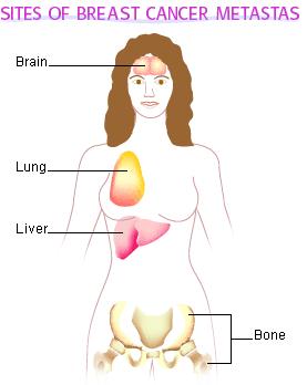 Stage IV Breast Treatment Lumpectomy, partial mastectomy or (MRM) modified radical mastectomy Sentinel lymph node bx and/or Axillary lymph node dissection Radiation therapy treat small number of