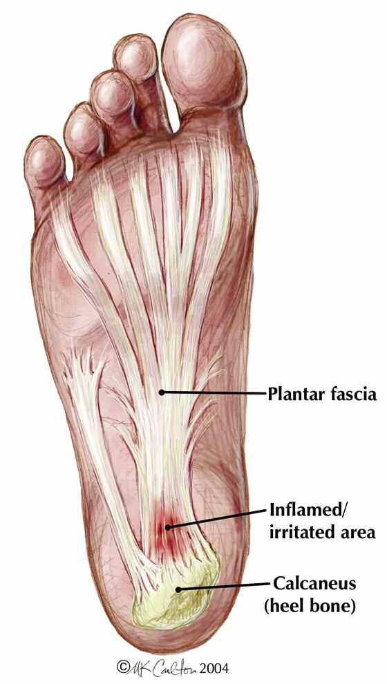 However, plantar fasciitis pain can, if it persists, soon be felt any time you are walking, running or jumping.