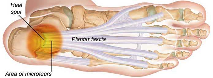 Pathophysiology Chronic degenerative process involving the plantar aponeurosis of the foot, most commonly at its insertion into the