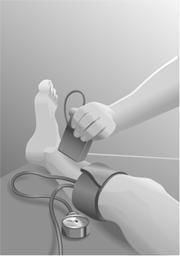Tourniquet Test Apply sphygmomanometer to affected ankle and
