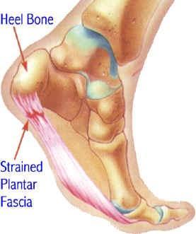 Strain of Plantar Fascia Related to tight achilles tendon and