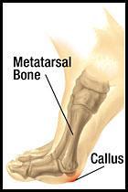 Metatarsalgia Sharp or shooting pain in toes Lack of