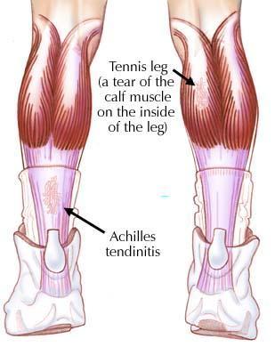 Achilles Tendonitis Over-training Lack of stretching Poor