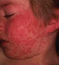 Infectious Diseases Cont Measles: Is a highly contagious viral disease characterized by a body rash