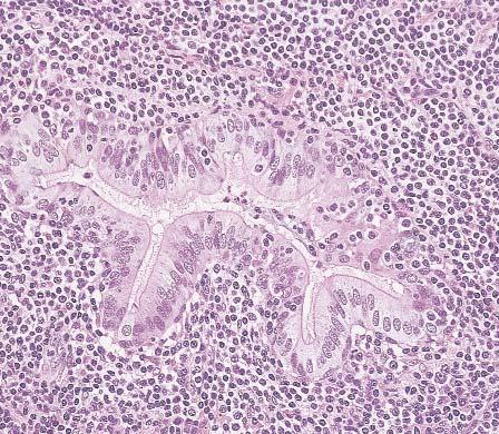 Kaleem et al / FLOW CYTOMETRIC IMMUNOPHENOTYPING IN B-CELL NON-HODGKIN LYMPHOMA Image 1 Pulmonary mucosa-associated lymphoid tissue type marginal zone lymphoma showing several lymphoepithelial