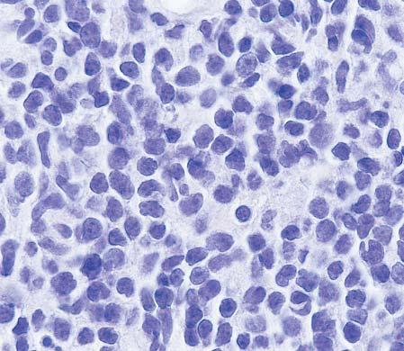 Image 2 Nodal CD5 mantle cell lymphoma that showed a monotonous proliferation of intermediate-sized cells with irregular nuclei and frequent mitoses (H&E, 400) that showed diffuse nuclear