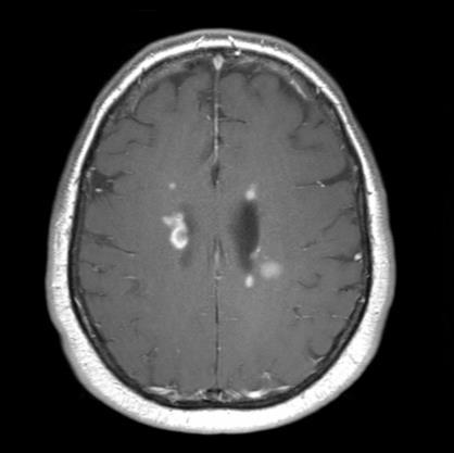 T1-Gd MRI at Baseline and Week 24: Study Subject