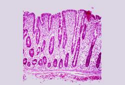 cells Increased intra-epithelial