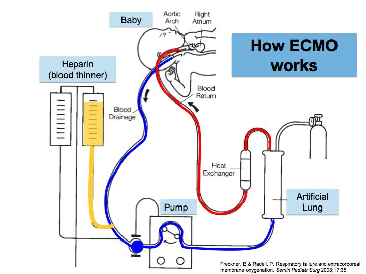 8/28/17 Role of ECMO: theory Allow lung rest and avoids baro-, volu-, stretch trauma. Maintains oxygenation and ventilation. Done with or without cardiac output support.