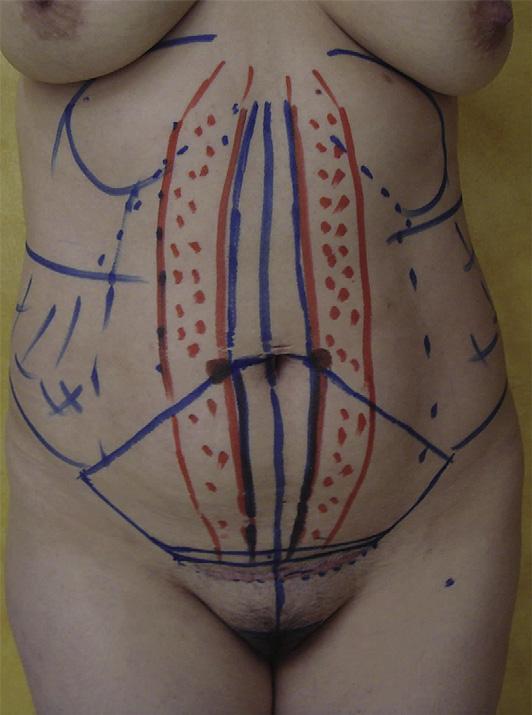 improvement on traditional abdominoplasty.