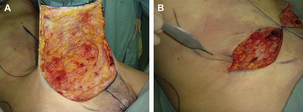 Lipoabdominoplasty: The Saldanha Technique 473 Fig. 12. (A) Scarpa fascia preservation. (B) Contention of scars laterally.