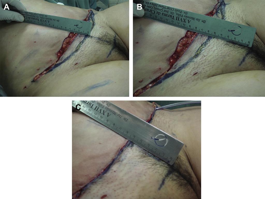 (B) Incision for omphaloplasty. (C) Final aspect of umbilicus. Fig. 19.