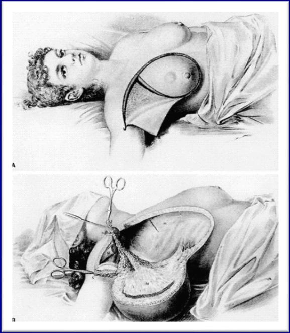 disease that arose in one location (the breast) and, if left untreated, spread