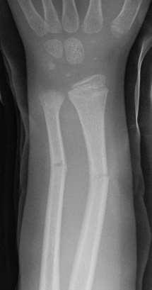 Bones What is a green stick fracture?