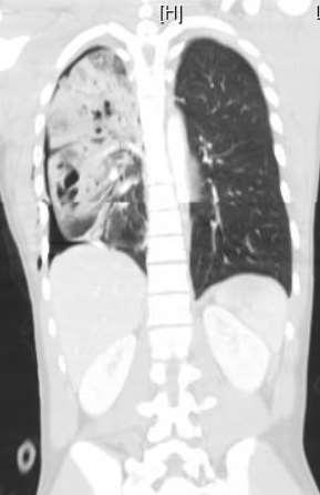 CT scan C/A/P Right pneumothorax Right lung contusion