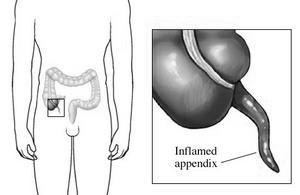 Appendicitis - patho Function of appendix is not fully understood Obstruction likely cause