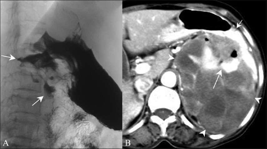 Imaging findings in Malignant GIST