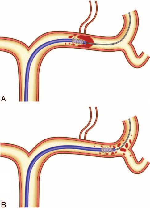 Fig 1. Disruption of the MCA thrombus by a deflated microballoon catheter; the catheter navigates into the thrombus in the MCA along the guidewire (A).