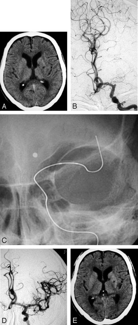 Fig 3. A 63-year-old man (case 7). A, A CT on admission shows no LDA. B, A preprocedural angiogram shows an occlusion of the left MCA trunk.