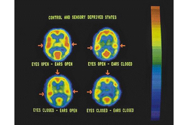tomography (PET Scan) A method for analyzing biochemical changes in the brain as they occur, using injections of a glucose-like substance containing a radioactive