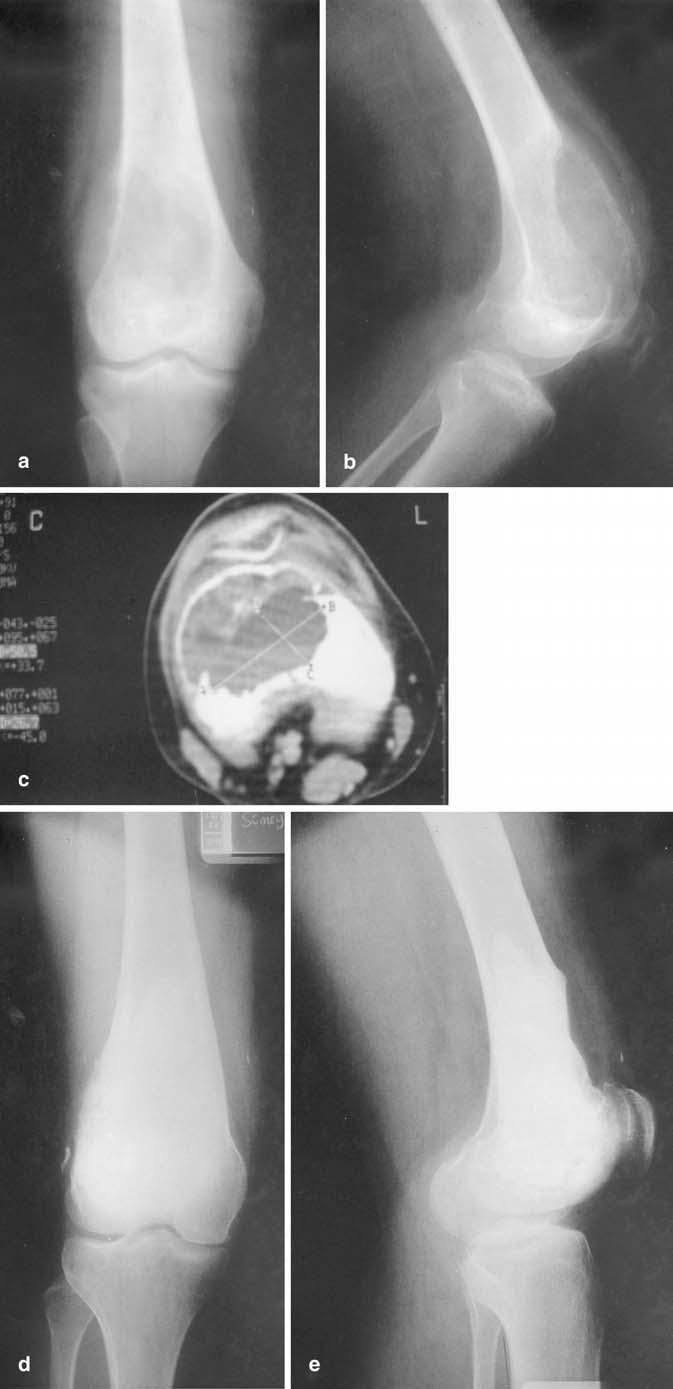 Fig. 3 (Case 9): A giant cell tumor involving the supracondylar area of the right femur treated by cryosurgery and acrylic cementation.