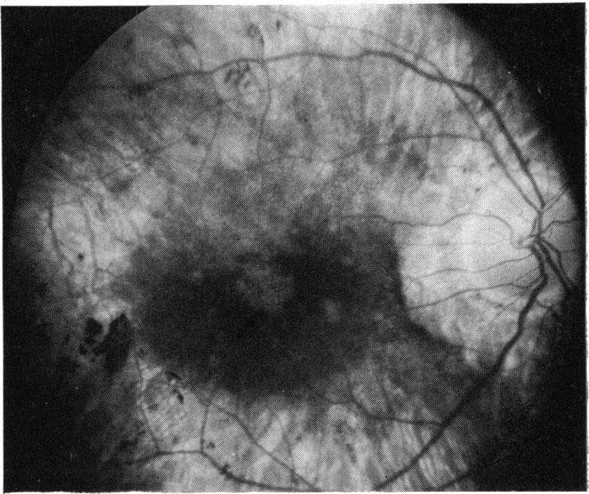 Visual loss and foveal lesions in Usher's syndrome 10% sodium fluorescein into an antecubital vein.