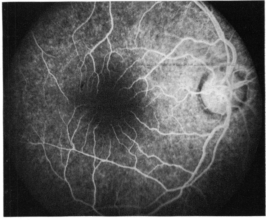 486 _; 4. Fig. 4 Cystic-appearing foveal lesions in right eye. Note extensive shimmering appearance ofperifoveal region associated with changes of internal limiting membrane Fig.