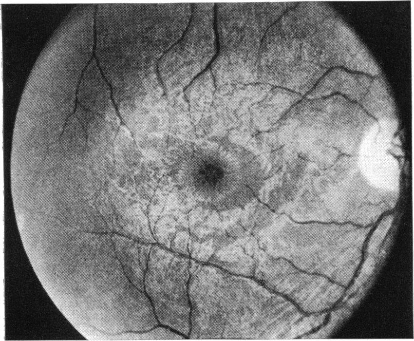 Note leakage from perifoveal capillaries ing foveal lesions showed central visual acuities between 20/30 and 20/50 in each eye.