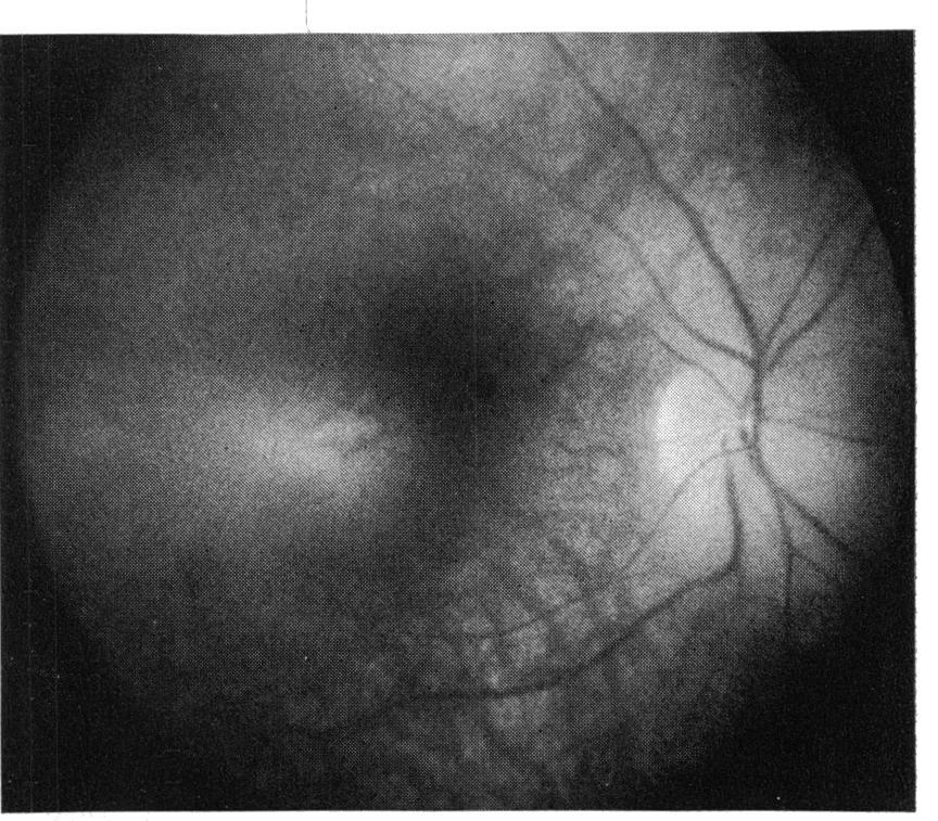 The remaining 12 patients showed atrophic-appearing changes that involved the foveola, and they had visual acuities of 20/60 or less in each eye.