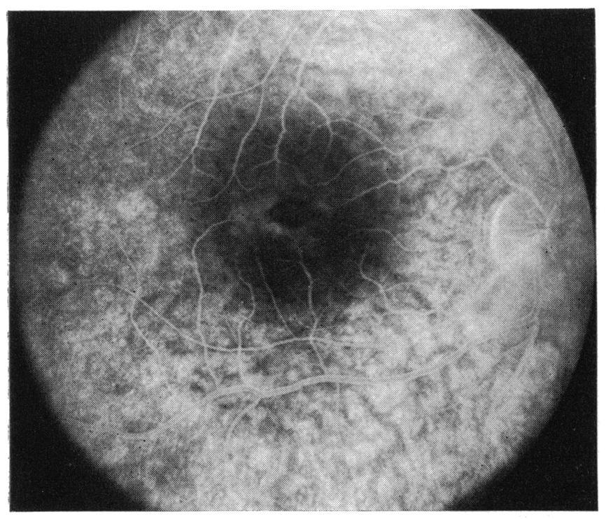 Since an intact internal limiting membrane was not evident on slit-lamp Gerald Fishman, Victoria Vasquez, Marlene Fishman, and Dale Berger Fig. 5 Fluorescein angiogram from patient shown in Fig. 4.