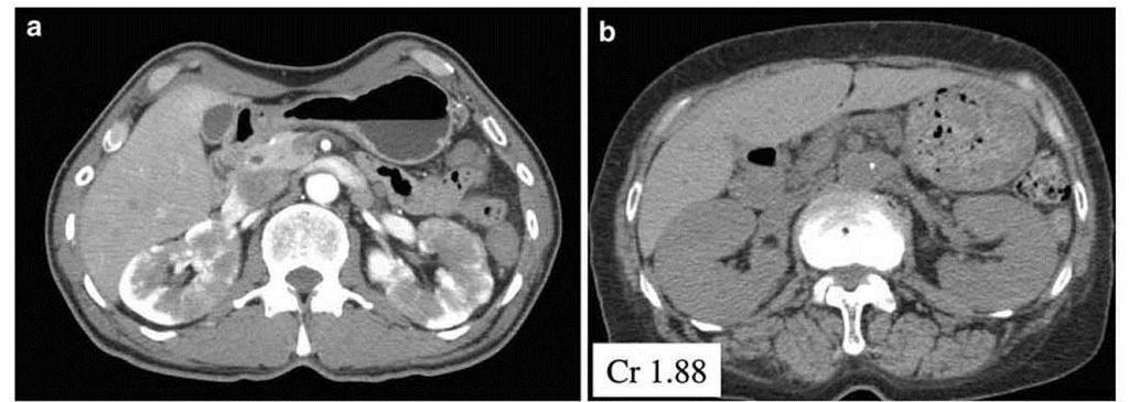 Characteristic CT imaging of IgG4-RKD Kawano et al.