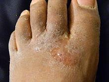 Skin Homeostatic Imbalances Infections Athlete s foot (tinea pedis) Caused by fungal