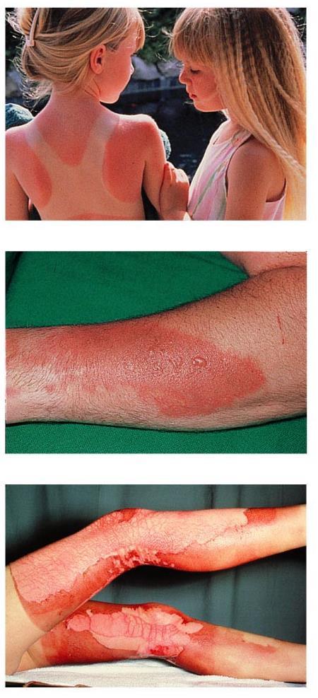 First-degree burns Only epidermis is damaged Skin is red and swollen Second-degree burns Epidermis and upper dermis are