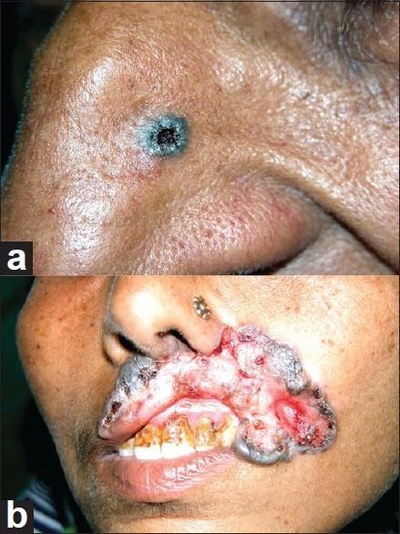 Skin Cancer Types I Basal cell carcinoma Least malignant Most common type Arises from stratum